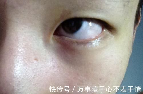 慢性肝炎|肝不好眼知道,两种迹象说明”肝癌“已经找上门,3招护眼更护肝