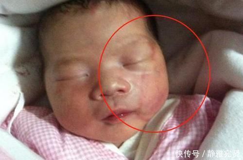 产妇|高龄产妇不听劝硬要生娃，顺产时医生被迫用产钳，女儿被毁容