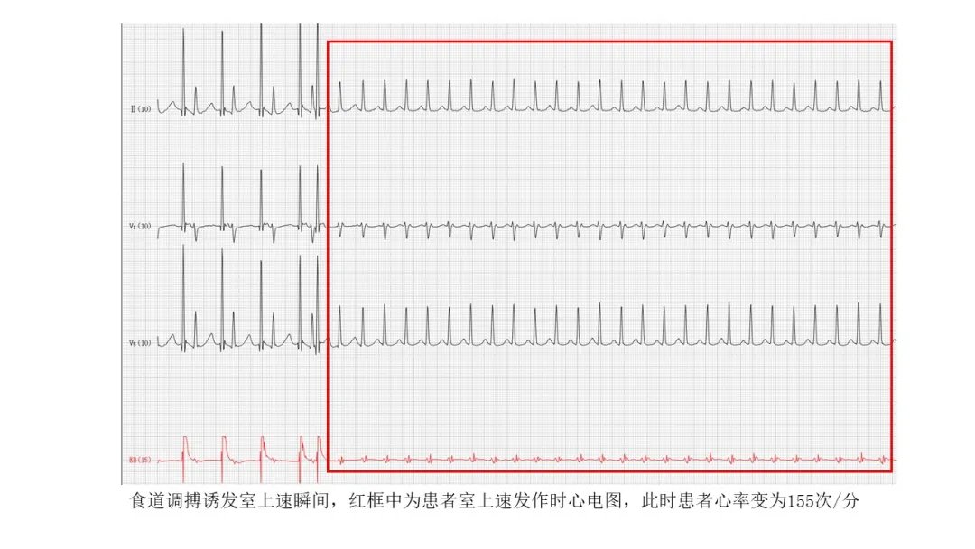 熬夜|24岁小伙熬夜玩游戏，总是莫名心慌，几分钟后又好转，医生“守株待兔”发现元凶
