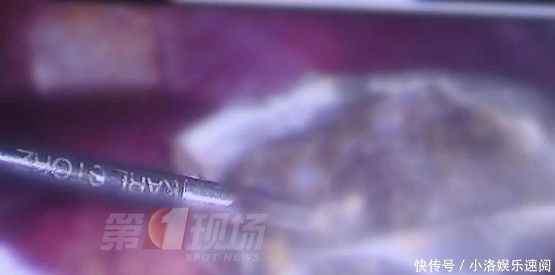 吃头发|头皮发麻14岁女孩胃里竟塞满…这个可怕习惯她保持了十年