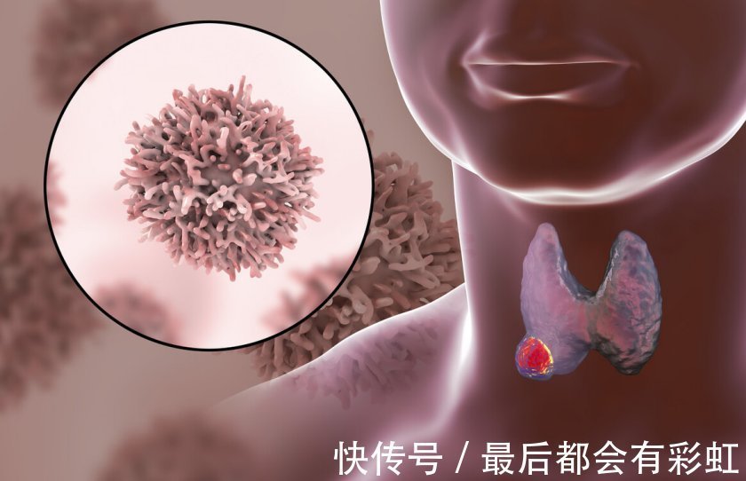 群体|甲状腺向身体发出的警报,往往被很多人忽视,这4类群体要谨慎