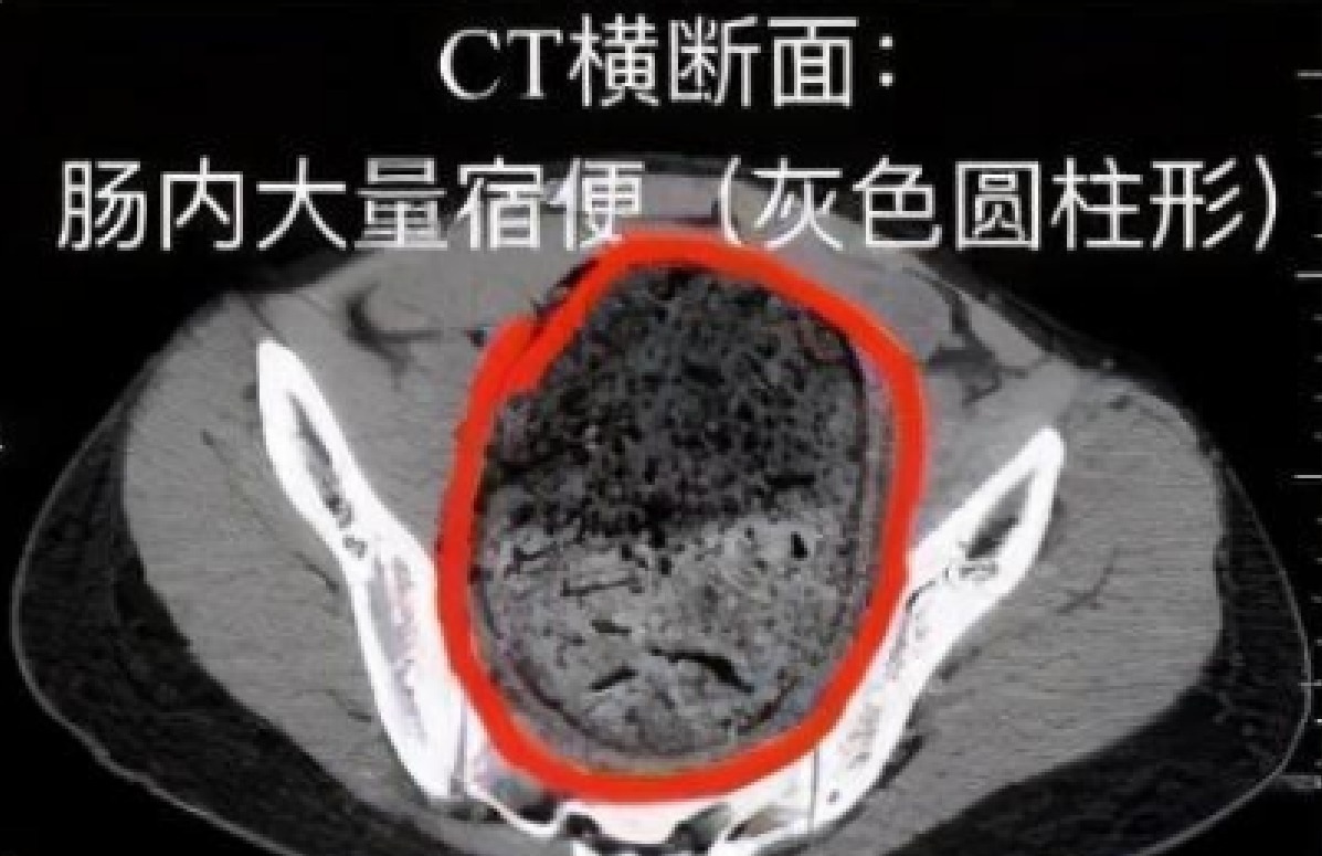  医生|女生肚子疼痛难忍，医生建议灌肠后，陆续排出16斤粪便