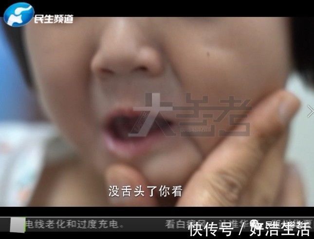疼痛|这个感受不到疼痛的3岁小女孩,却让很多人心疼