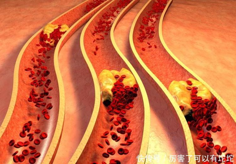 疾病的发生|入秋前后,心血管最敏感,不想血管出问题,5道家常菜尽量少吃