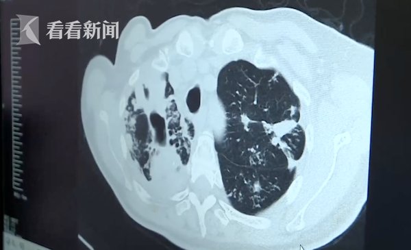 工作压力|工作压力大！22岁男子饮酒助眠 1年后＂喝＂到吐血