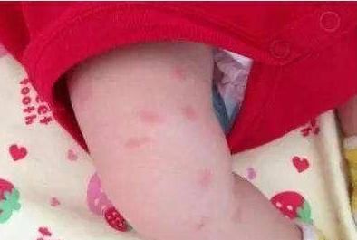 罪魁祸首|5个月的宝宝患皮肤病，罪魁祸首就是此物，很多宝妈都在用
