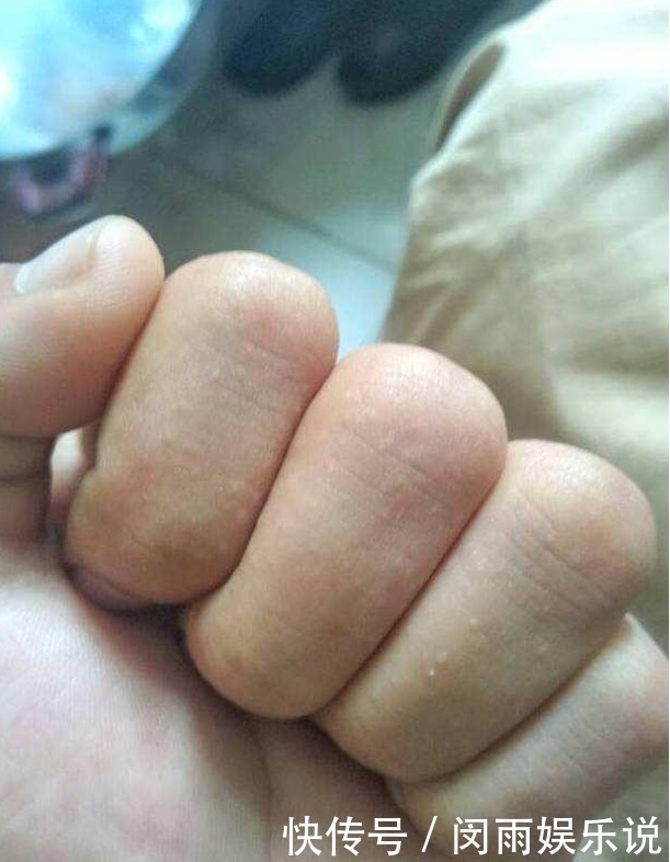 汗疱疹|手脚总起小水泡,奇痒难忍,警惕:是身体这个“器官”出问题了