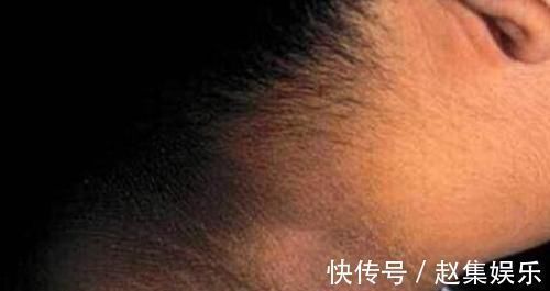 高热量|9岁小女孩脖颈发黑洗不掉,去医院检查后,医生的解释让家长笑了