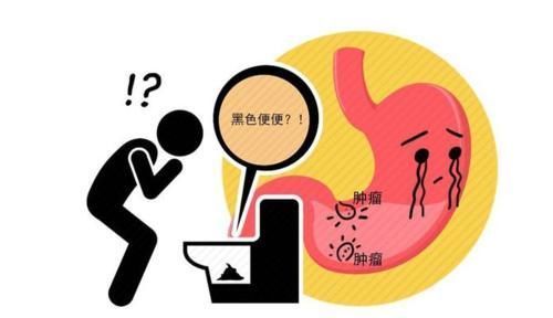 腹泻|直肠癌多半是拖出来的?4种异常迹象,暗示直肠已“亮红灯”