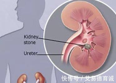 胱氨酸结石|预防肾结石一定要管住嘴，从结石成分来看饮食也是很重要的