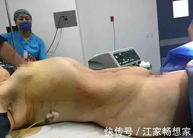 良性肿瘤|33公斤!史上最大的卵巢肿瘤!被医生整个从腹腔里取出了