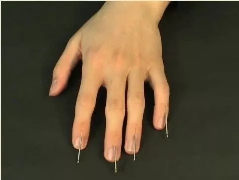 董氏奇穴木火穴:治疗半身不遂奇效