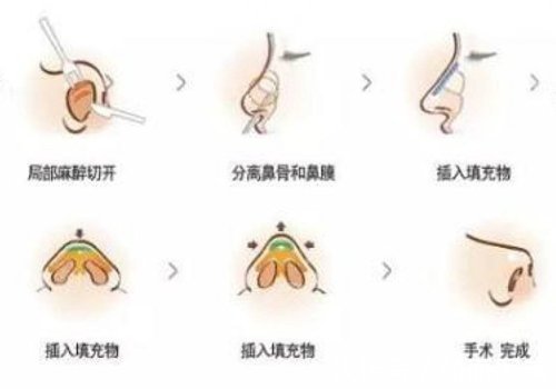 攻略 美鼻攻略|耳软骨隆鼻恢复期多久?注意事项+术后护理盘点!