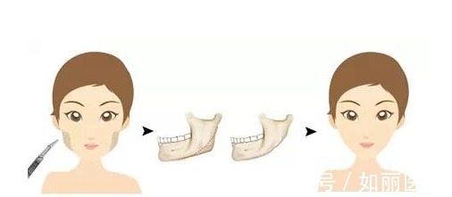 下颌角整形 下颌角磨骨恢复期需要多久？术后有哪些需要注意的，你都知道吗？