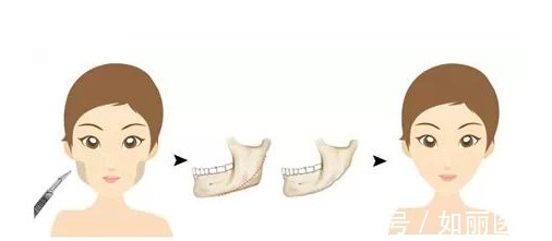 下颌角整形 下颌角磨骨恢复期需要多久?术后有哪些需要注意的,你都知道吗?