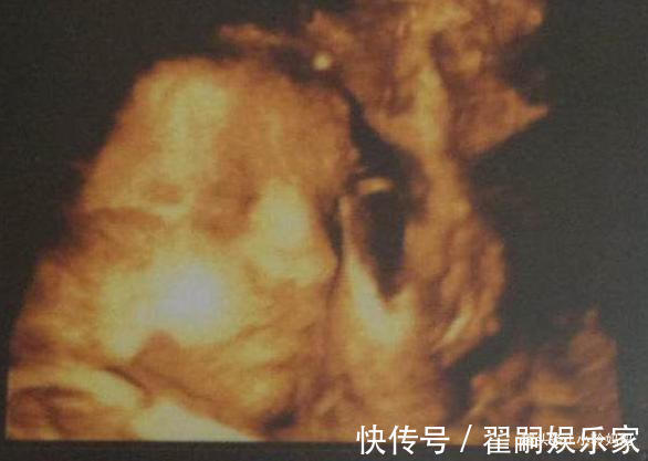 医生|7个月孕妈去产检，发现胎儿“捂鼻子”，了解情况后医生怒斥孕妈