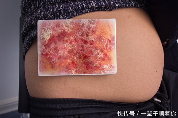 癌症|红斑狼疮,为何被称为“不死的癌症”危害到底有多大