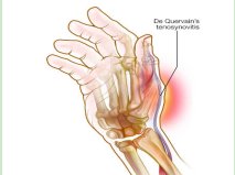 桡骨茎突狭窄性腱鞘炎|“妈妈手”是怎么形成的？它可不是妈妈的专利