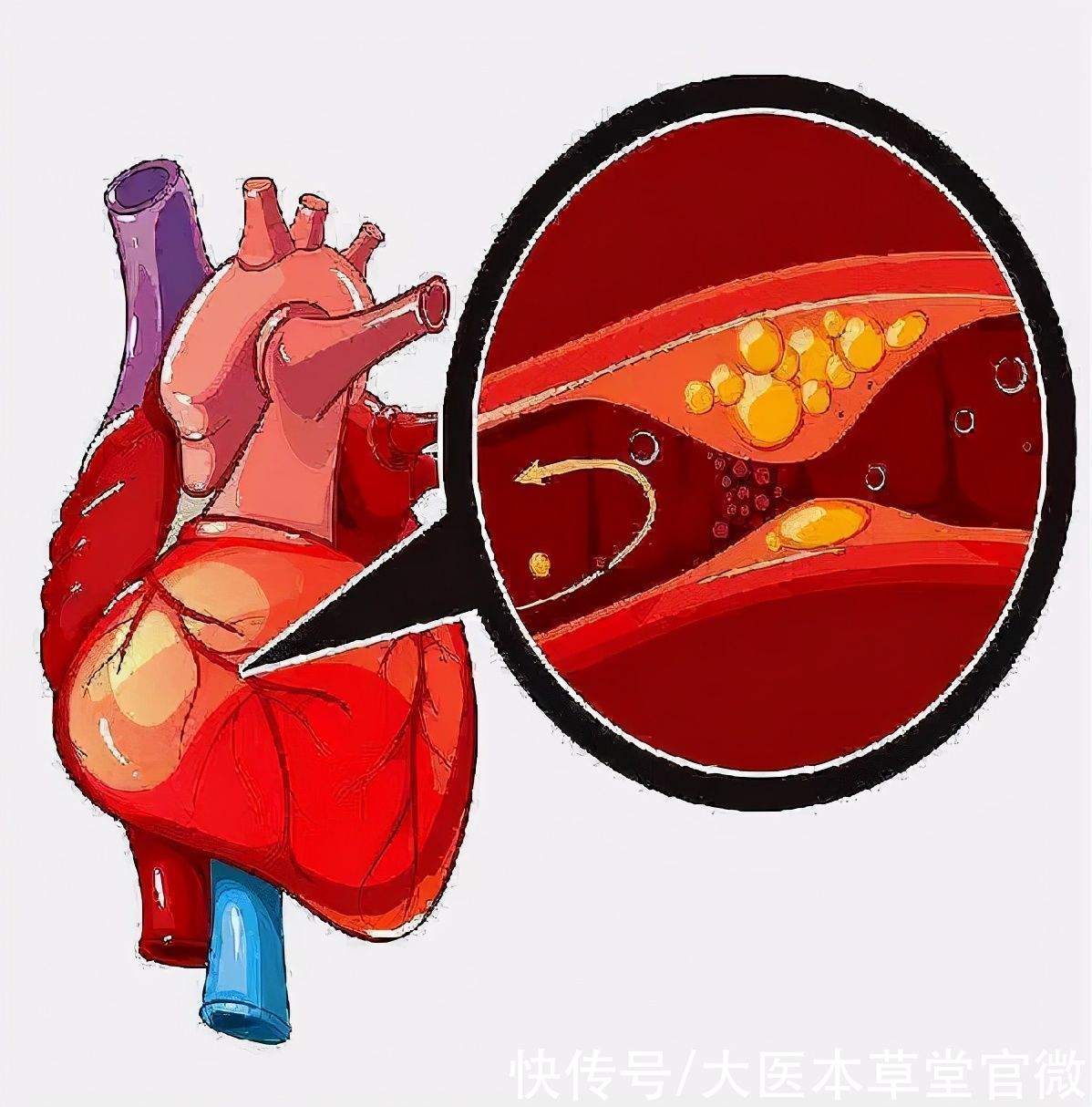 心脏|夏季，心脏有＂2怕＂，不想心梗，提醒：这5件事，少做一个也好