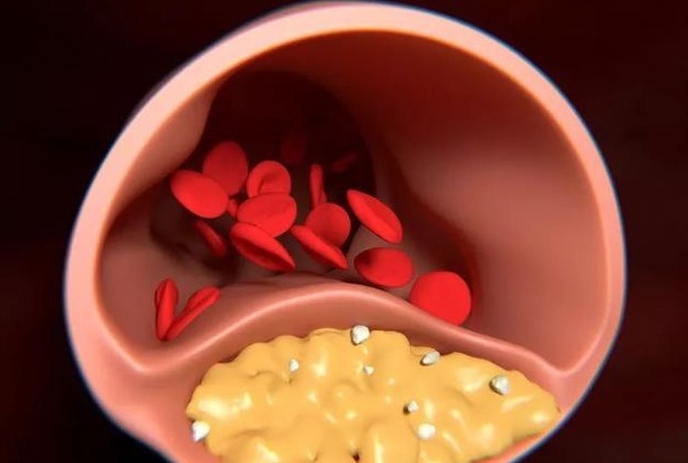 苏子油|血管不好,手先知,手上出现3个迹象,暗示血管已经很堵了