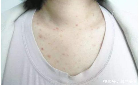 异位性皮炎|床铺螨虫多,家里孩子常过敏,教你一个土办法,螨虫连根拔起