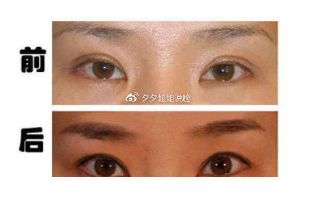 双眼皮修复风险大吗，都有哪些方法？