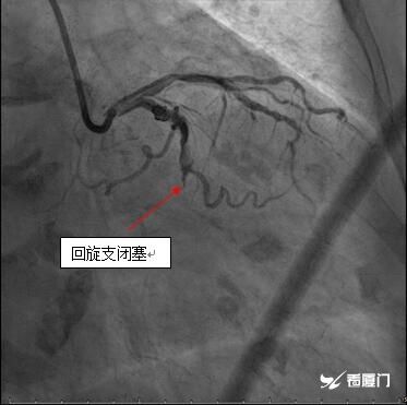 附属|快速!他们为95岁急性心梗老人开通血管