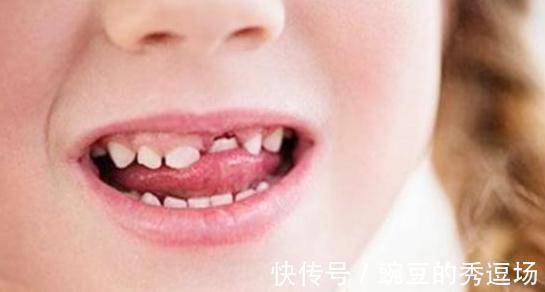 恒牙|孩子乳牙整齐漂亮,换牙后却越来越歪?可能是这几点没做好