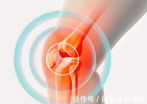 膝盖|膝盖肿有积液?一妙方消肿止痛,活血化瘀,专家说一月赶走滑膜炎