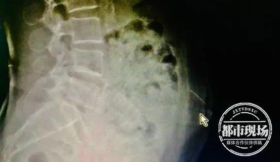 梁婆婆|67岁老人自行针灸,针断腹中!她又想自己开口子取出