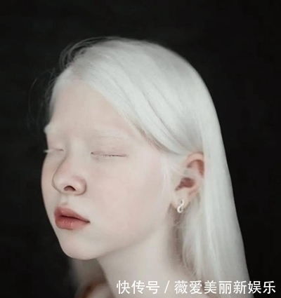 白化病|一对罕见的“月亮姐妹”,被人嘲讽14年,拍完一组照片后惊艳众人