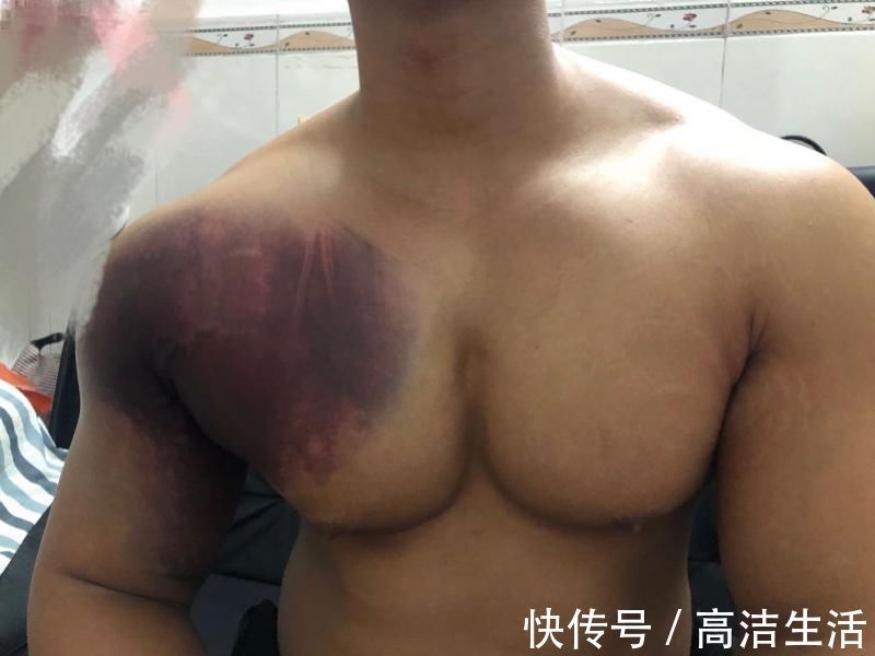 胸大肌|健身教练卧举380斤失败胸大肌被生生撕脱