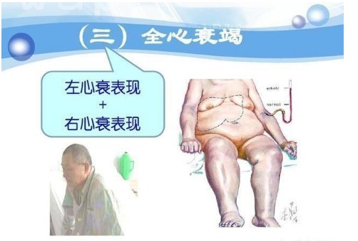 脑梗死|高血压会影响寿命医生辟谣控制好血压照样长寿