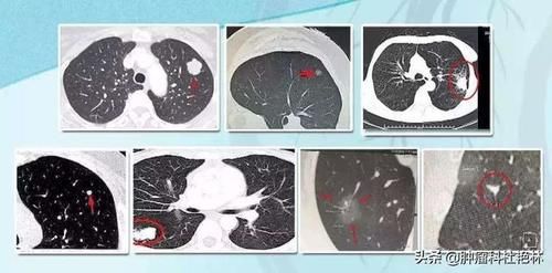  案例|案例：又两名肺结节患者，通过服用虫类药，结节消失