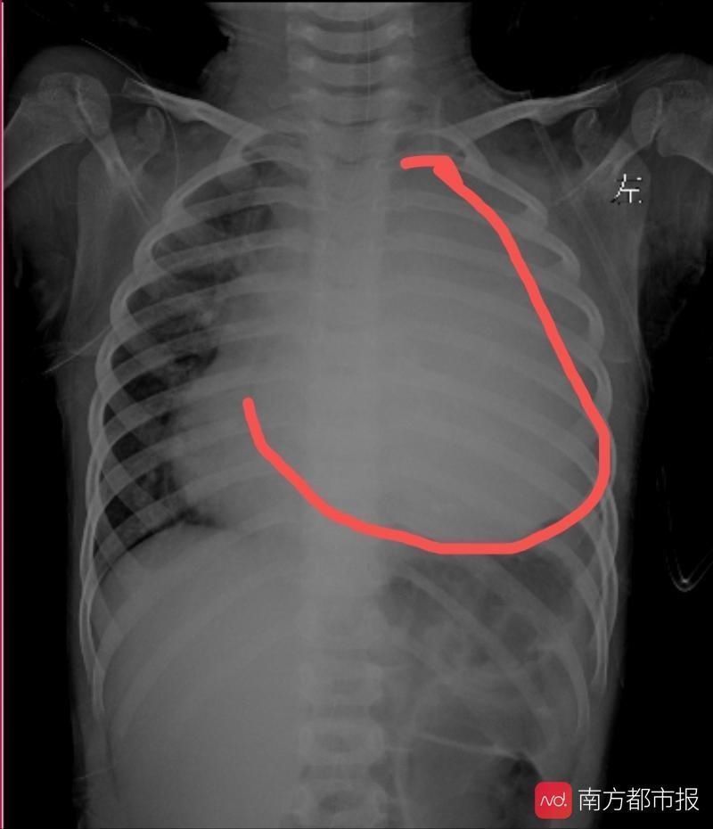 副教授|【南方都市报】庞大良性瘤长在了三岁孩子的高危区域 团队出战成功卸除