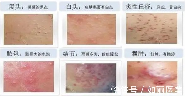 痤疮 怎么去痘|日常战痘还不够,4种医美光电项目来帮你get干净皮肤!