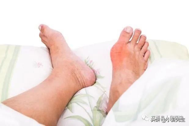高尿酸的祸根找到了,平时少吃1黄2白,并做好3事,尿酸稳稳的