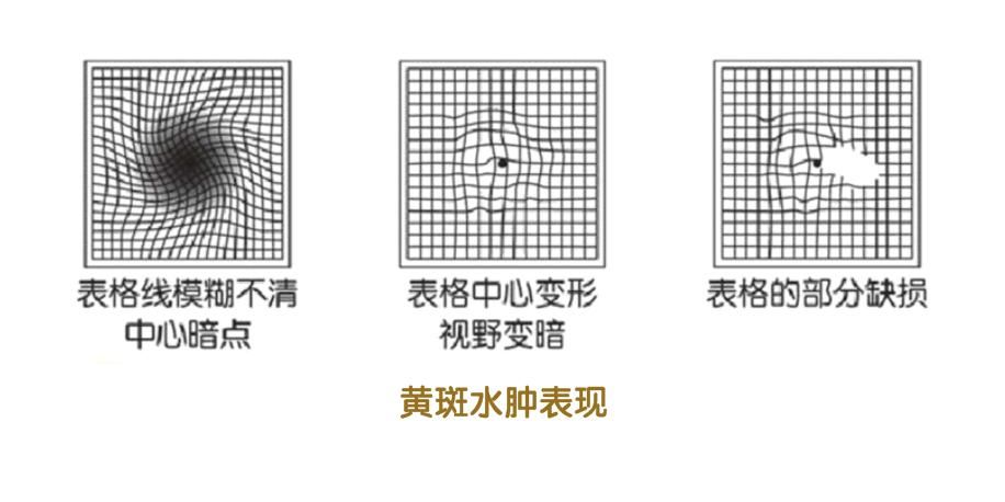 眼睛|眼睛长黄斑别大意！延误治疗时机当心失明