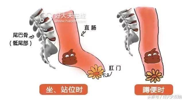 蹲便|便秘人群,蹲便好,还是坐便好啊?哪个让你排便更顺畅!
