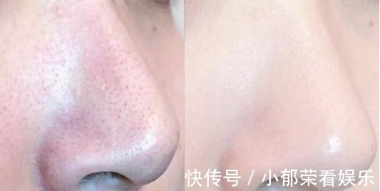 洗面奶|刚打湿脸就涂洗面奶,难怪黑头越长越多,告诉你正确的洗脸方法