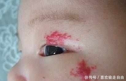 太田母斑|以为宝宝的前额是胎记,但是医生诊断后妈妈后傻眼了