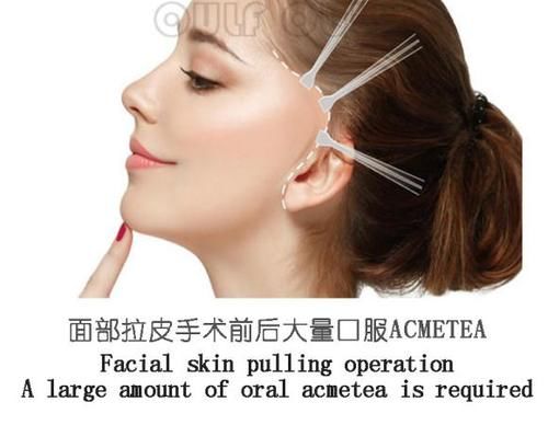 每日一问中面部拉皮手术你做了吗？居然还有人不知道啥是中面部拉皮手术？