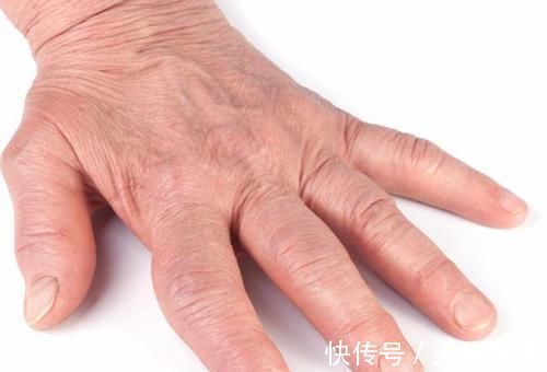 血管|当手上有这4个信号，表示血管堵塞很严重，要及时治疗