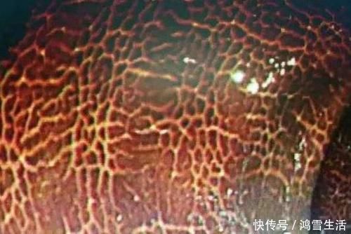 有個(gè)部位變黑,也許是“腸癌”已經(jīng)找上門(mén),早了解早預(yù)防