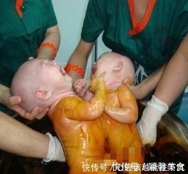 双胞胎|产妇孕期产检，看B超以为是双胞胎，孩子出生后全家却乱作一团