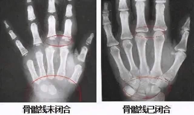 儿科医生|父母都是高个子,孩子为什么长不高?儿科医生告诉你