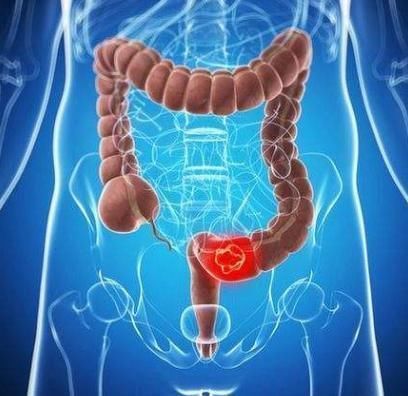  大便不成形、还次数增加或放屁多专家其实暴露了3个健康问题