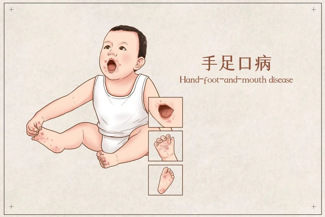 肠道病毒|手足口病、疱疹性咽峡炎夏秋季高发，家长需注意！