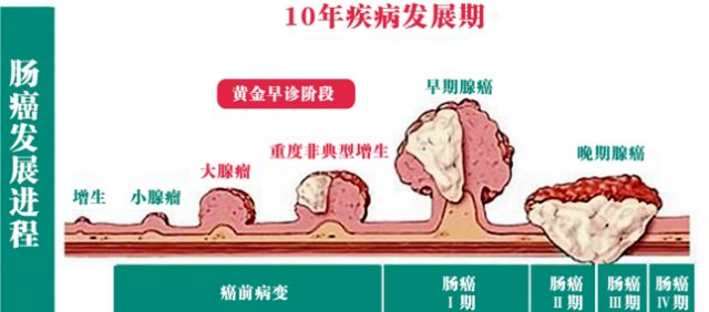 结直肠癌|“球王”贝利发现结肠肿瘤，45岁以后请每年做这项检查