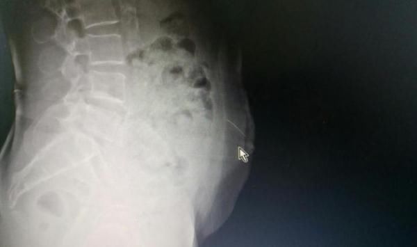 意外|阿婆自行针灸出意外，5厘米断针留在腹中